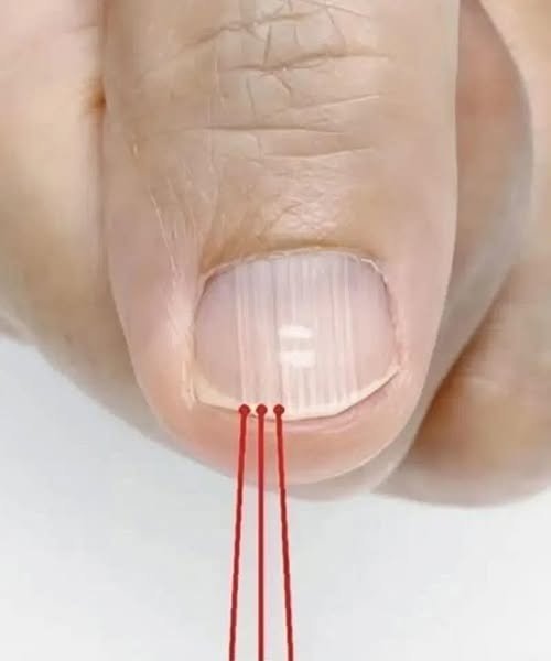 If you have these lines on your nails after 40, it is a clear sign that.. 813020871_122111726829451457_283634115675748112_n (1)