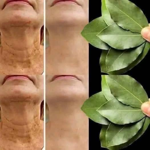 Is Bay Leaf 100,000 Times Stronger Than Botox? The Truth About This Viral Natural Wrinkle Remedy 813645738_122103512685475772_4565695848088009312_n