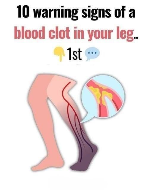 10 Warning Signs of a Blood Clot in Your Leg You Should Know 814971285_1547630670729661_4841745141514618545_n (1)
